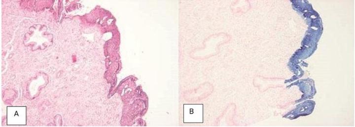 Monsel’s solution (ferric subsulfate solution) is a topical hemostatic agent used to control bleeding following mucosal biopsy. It causes coagulation and necrosis of the mucosal surface. If it is applied before a biopsy is taken it causes local basophilia