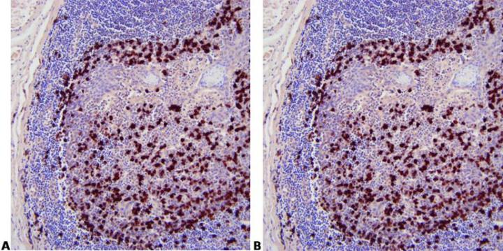 These sections of tonsil stained with ISH for kappa light chain show how washing affects the result. Section A shows excessive background staining due to poor washing technique while section B was properly washed and has no background staining.