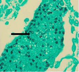 PNEUMOCYSTIS APPEAR AS BLACK BALLS WITH LIGHT GREEN BACKGROUND