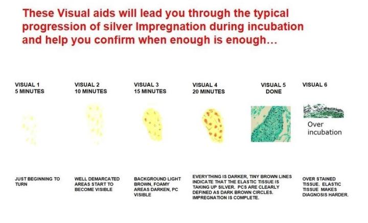 GMS for Pneumocystis