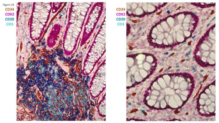 Figure 1B The value of multiplex staining